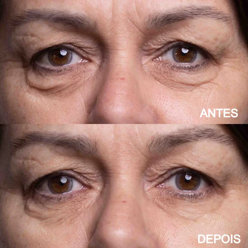 Antes e depois